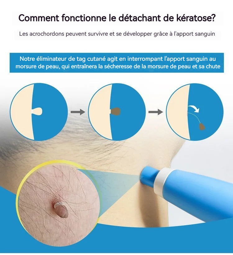 Outil double tête pour l'élimination des verrues - Éliminez vos verrues cutanées sans douleur à domicile