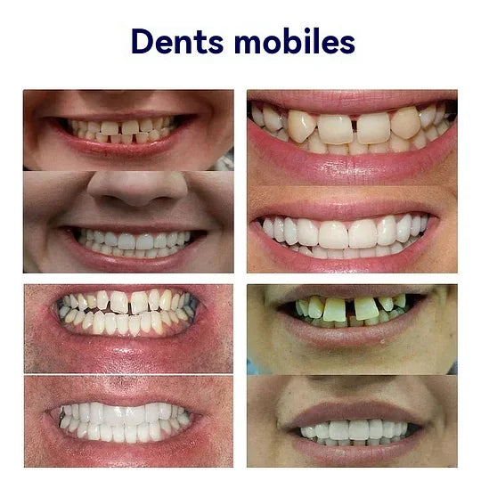 Prothèse dentaire complète personnalisée de pointe