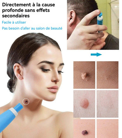 Outil double tête pour l'élimination des verrues - Éliminez vos verrues cutanées sans douleur à domicile