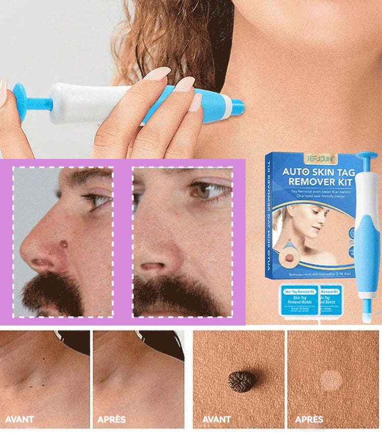 Outil double tête pour l'élimination des verrues - Éliminez vos verrues cutanées sans douleur à domicile